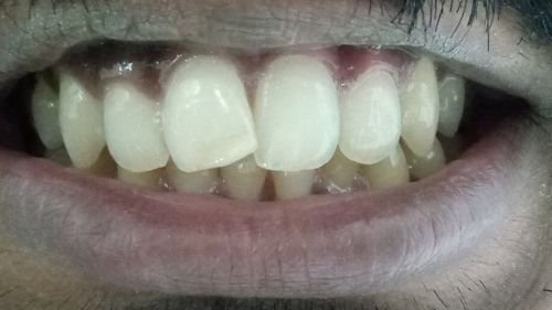 Veneers