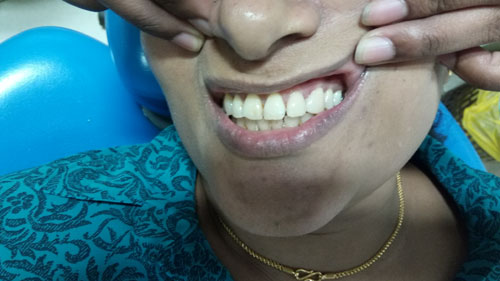 Veneers