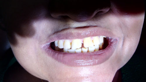 Veneers