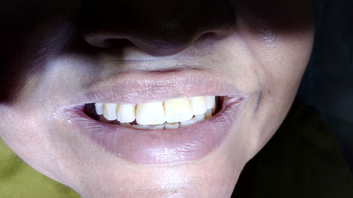 veneers